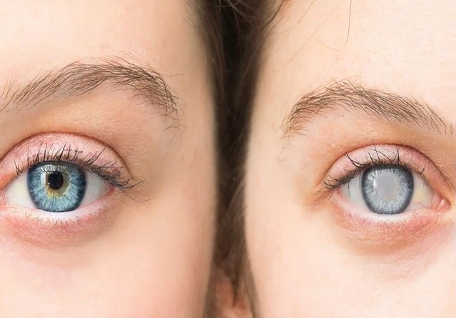 аллергия и катаракта